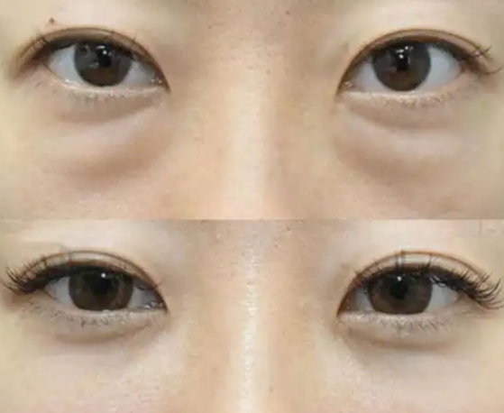 眼袋