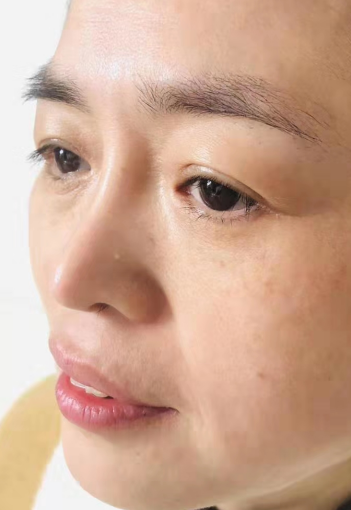 去眼袋手术