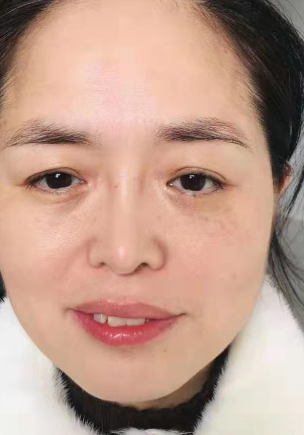 去眼袋手术