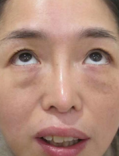 去眼袋手术