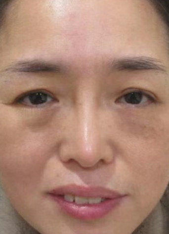 去眼袋手术
