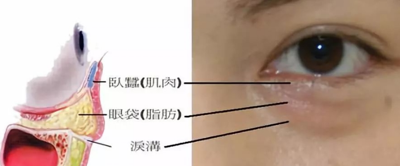 去眼袋手术
