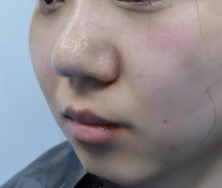 去眼袋手术