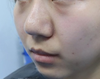 去眼袋手术