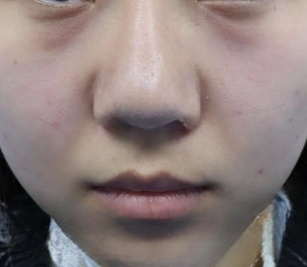 去眼袋手术