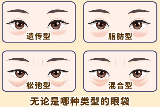 去眼袋手术