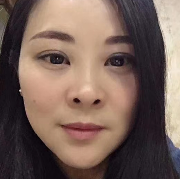 去眼袋手术