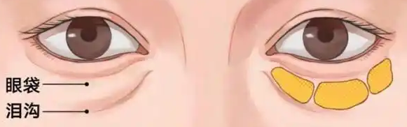 去眼袋手术