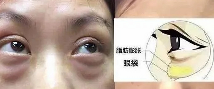 去眼袋手术