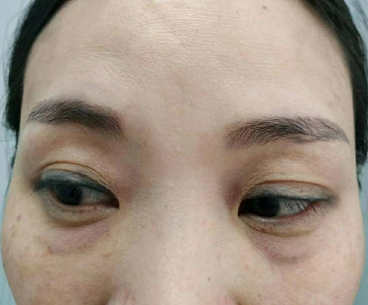 去眼袋手术