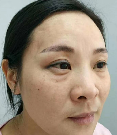 去眼袋手术