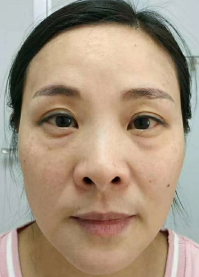 去眼袋手术
