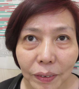去眼袋手术