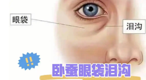去眼袋手术