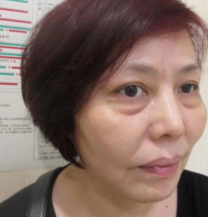 去眼袋手术