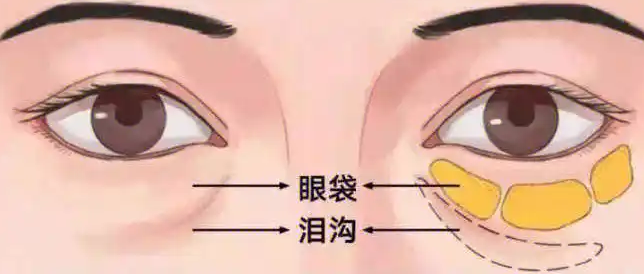 去眼袋手术
