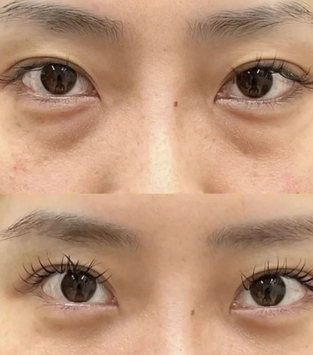 去眼袋手术