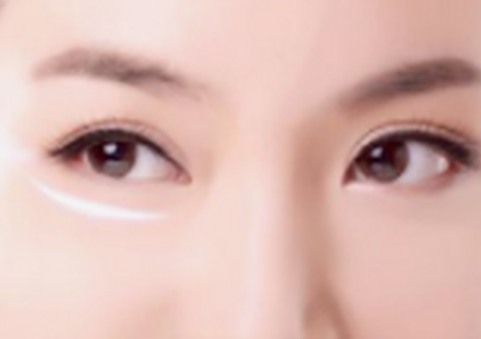 去眼袋手术