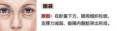 眼袋