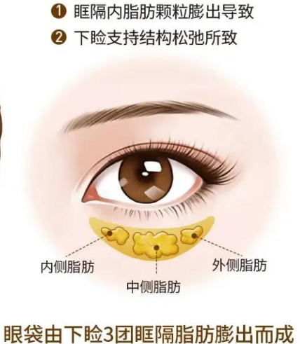 眼袋