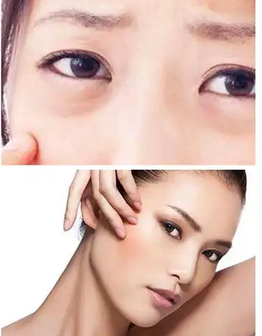 眼袋