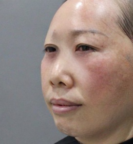 去眼袋手术