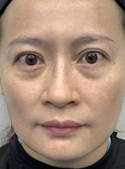 去眼袋手术