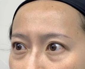 去眼袋手术