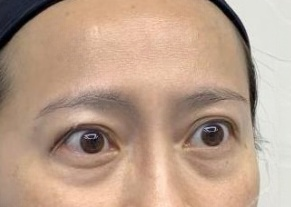 去眼袋手术