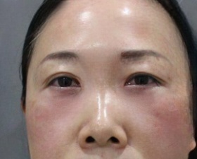 去眼袋手术