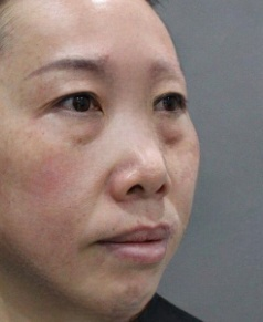 去眼袋手术