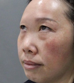 去眼袋手术