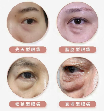 去眼袋手术