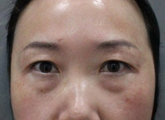 去眼袋手术