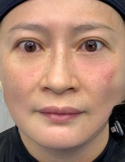 去眼袋手术