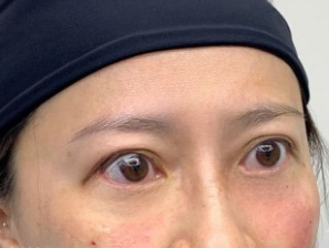 去眼袋手术