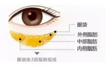 去眼袋手术