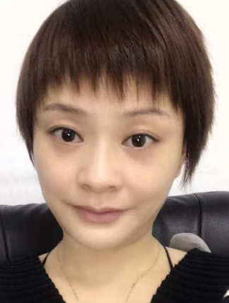 去眼袋手术