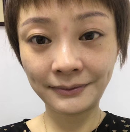 去眼袋手术