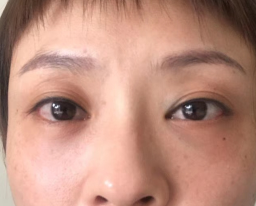 去眼袋手术