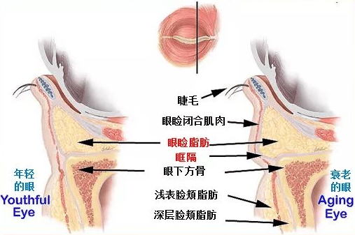 去眼袋手术