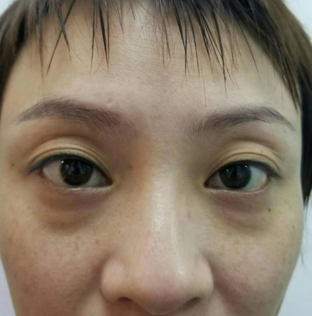 去眼袋手术