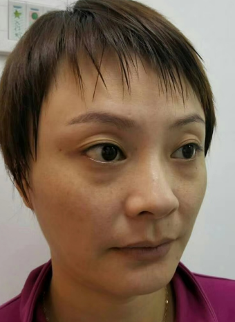 去眼袋手术