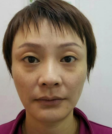 去眼袋手术