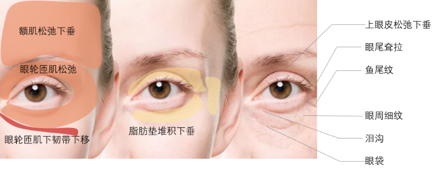 去眼袋手术
