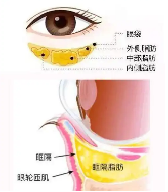 去眼袋手术