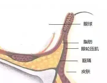 去眼袋手术