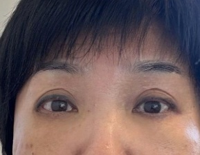 去眼袋手术