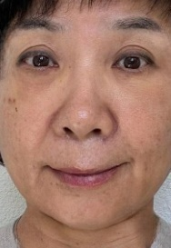 去眼袋手术
