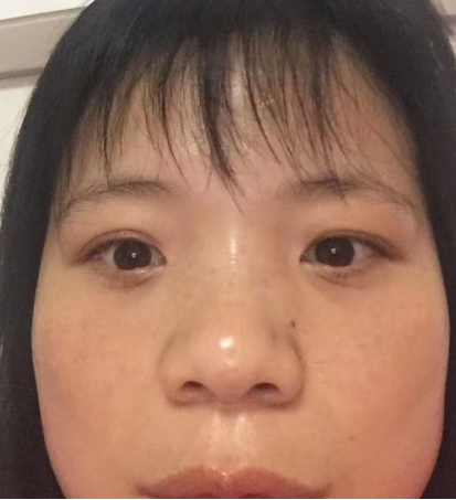 去眼袋手术
